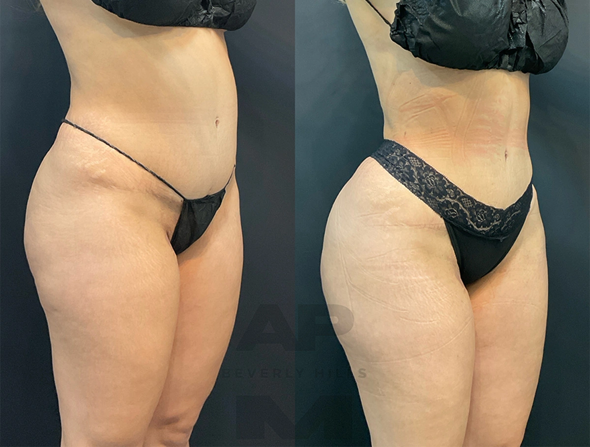 Real Patient Results by Dr. Marshall or Andrew P. Marshall Plastic Surgery serving Beverly Hills & Los Angeles, CA