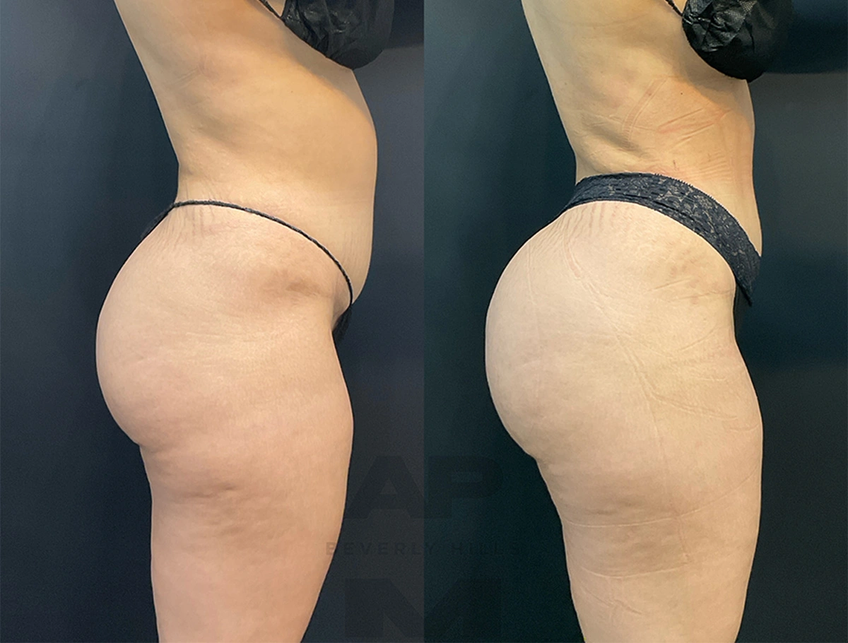 Real Patient Results by Dr. Marshall or Andrew P. Marshall Plastic Surgery serving Beverly Hills & Los Angeles, CA