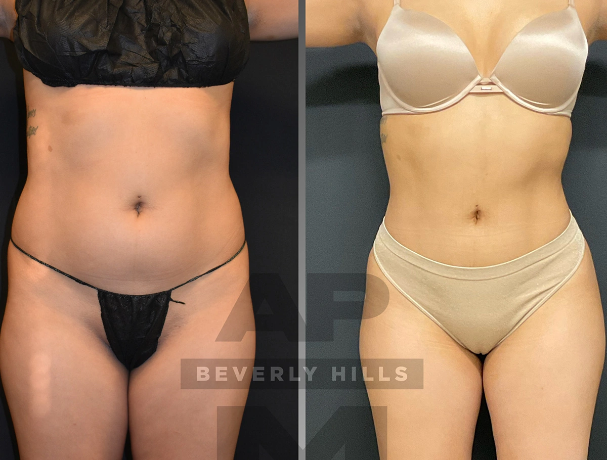 Real Patient Results by Dr. Marshall or Andrew P. Marshall Plastic Surgery serving Beverly Hills & Los Angeles, CA