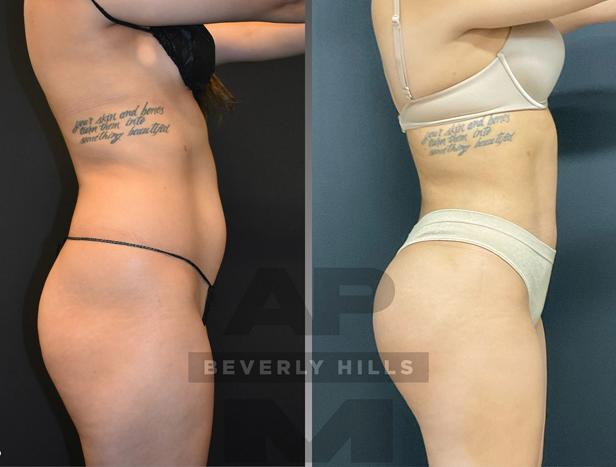 Real Patient Results by Dr. Marshall or Andrew P. Marshall Plastic Surgery serving Beverly Hills & Los Angeles, CA
