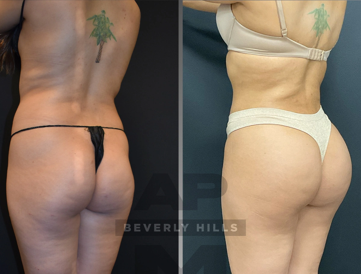 Real Patient Results by Dr. Marshall or Andrew P. Marshall Plastic Surgery serving Beverly Hills & Los Angeles, CA