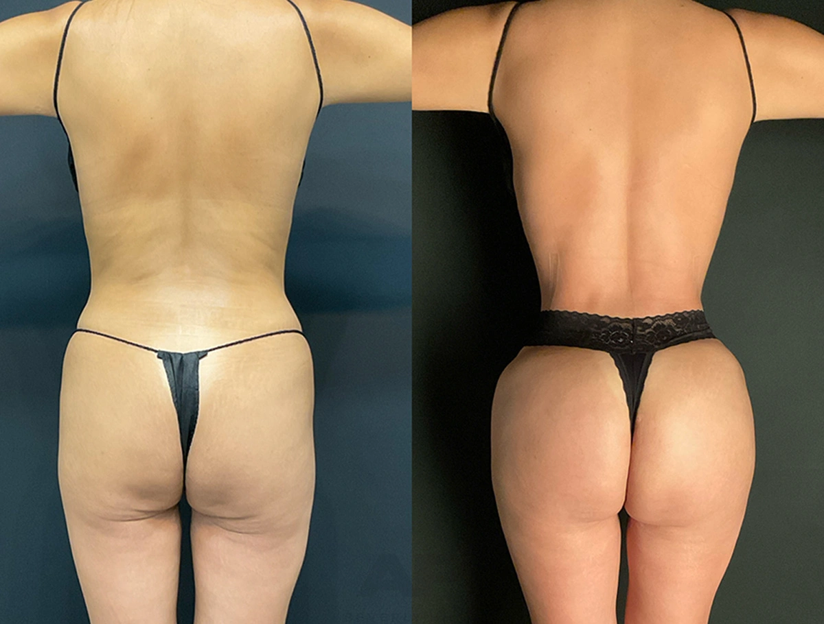 Real Patient Results by Dr. Marshall or Andrew P. Marshall Plastic Surgery serving Beverly Hills & Los Angeles, CA