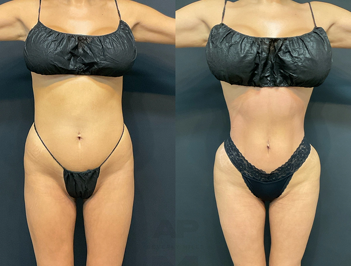 Real Patient Results by Dr. Marshall or Andrew P. Marshall Plastic Surgery serving Beverly Hills & Los Angeles, CA