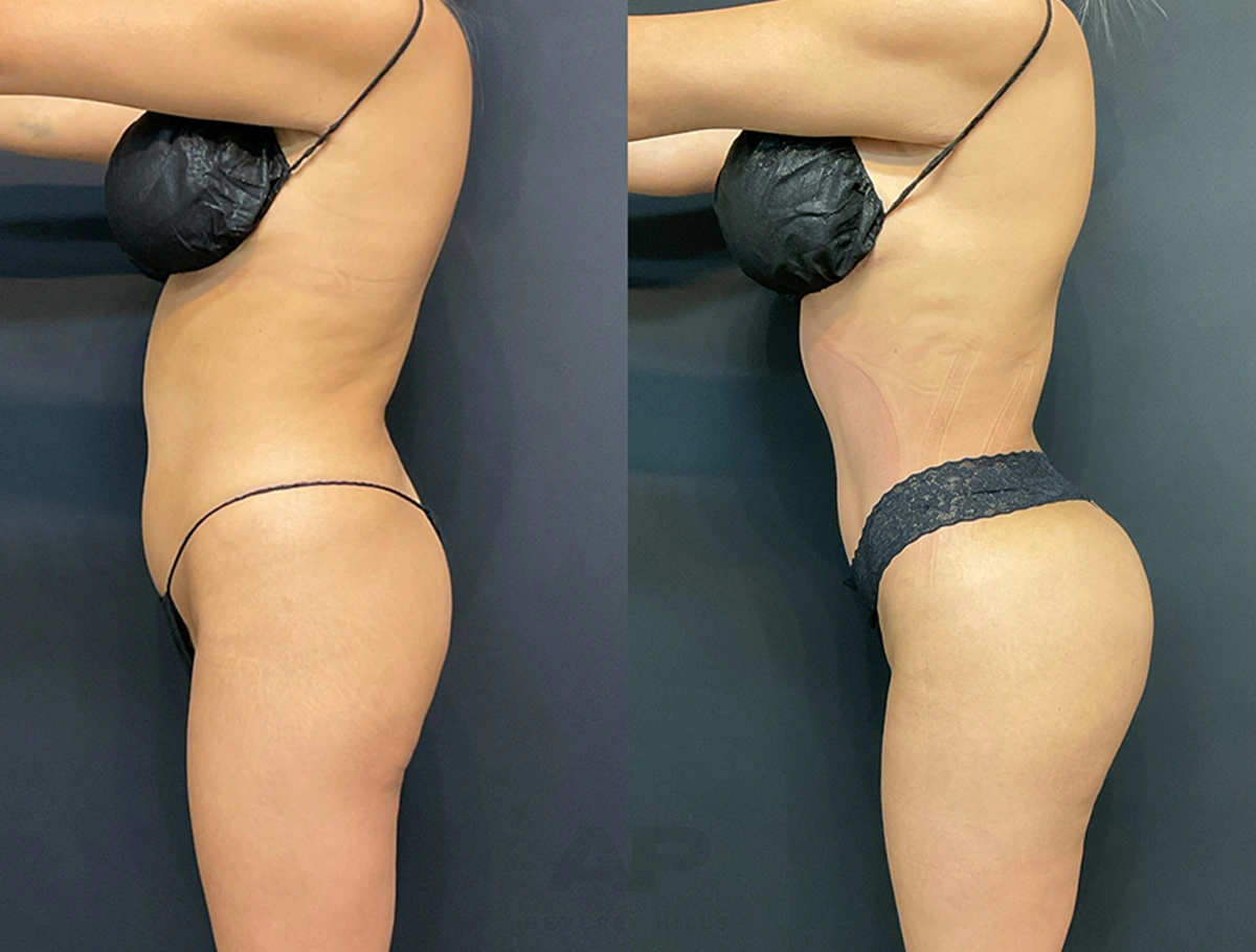 Real Patient Results by Dr. Marshall or Andrew P. Marshall Plastic Surgery serving Beverly Hills & Los Angeles, CA