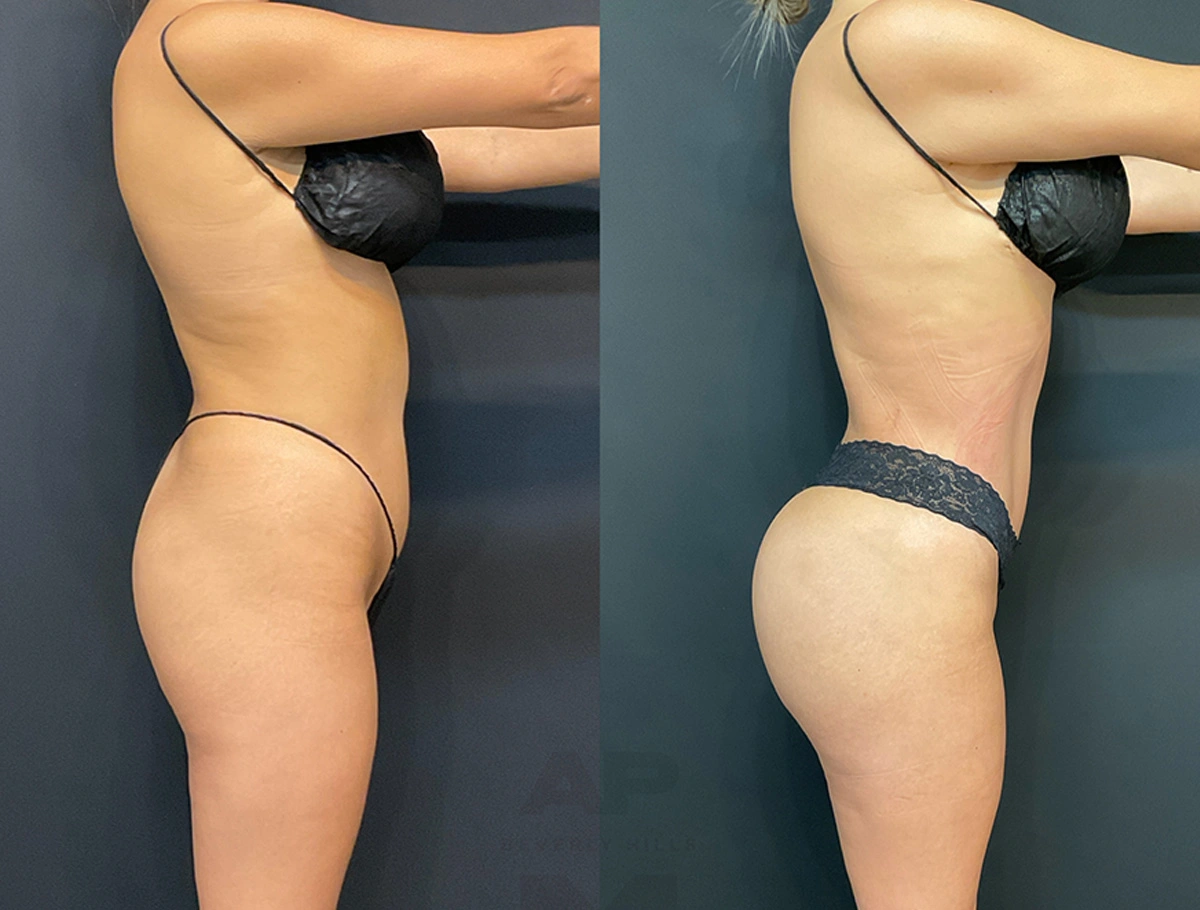 Real Patient Results by Dr. Marshall or Andrew P. Marshall Plastic Surgery serving Beverly Hills & Los Angeles, CA