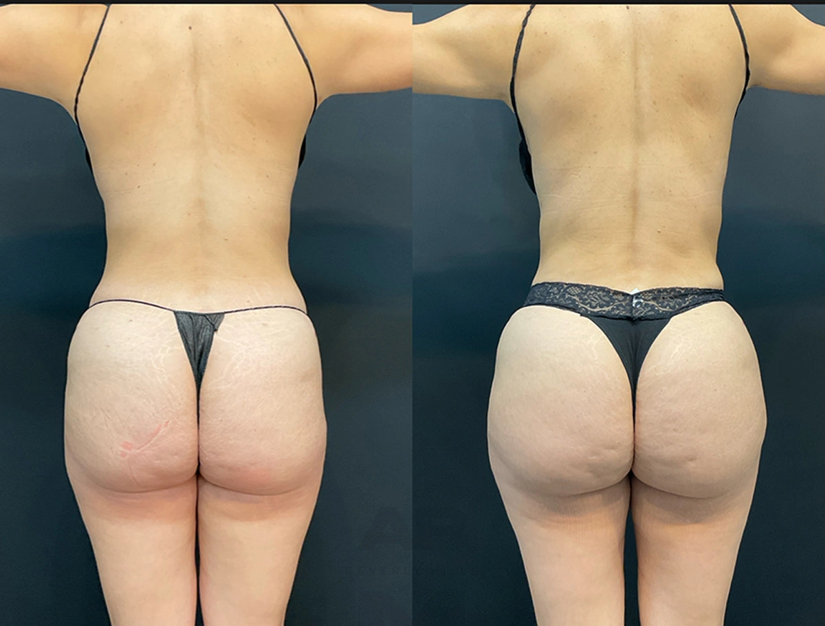 Real Patient Results by Dr. Marshall or Andrew P. Marshall Plastic Surgery serving Beverly Hills & Los Angeles, CA