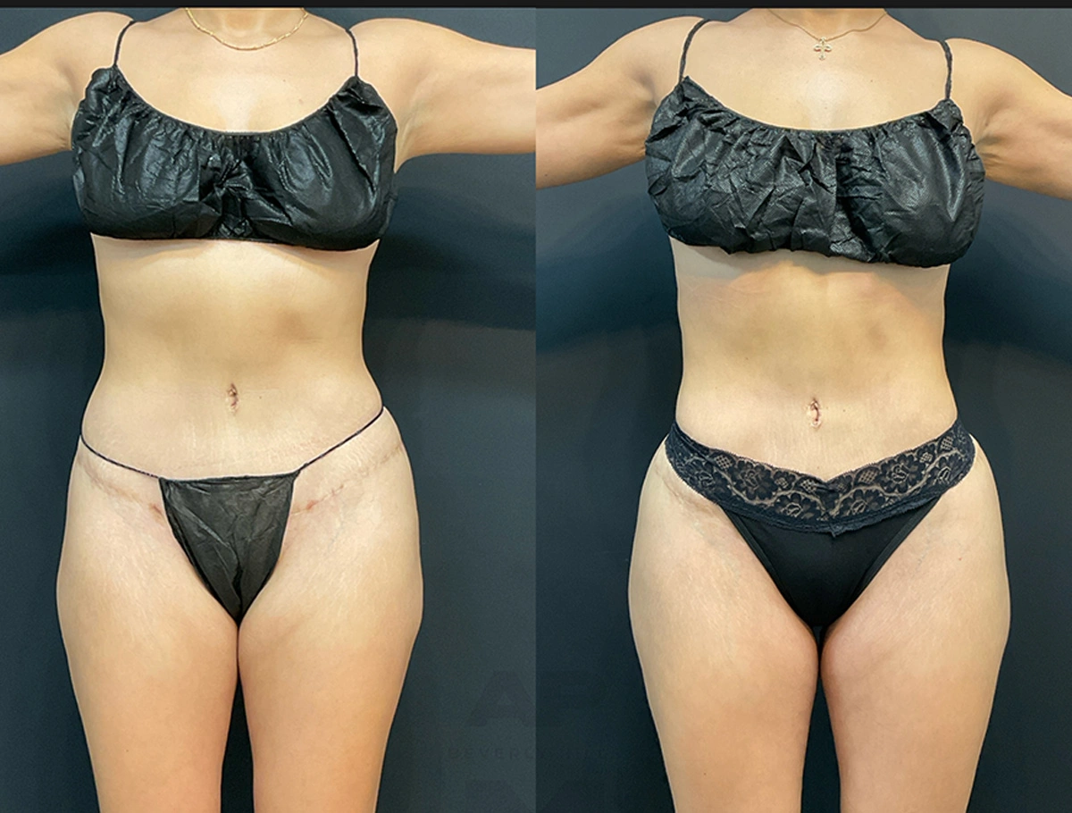 Real Patient Results by Dr. Marshall or Andrew P. Marshall Plastic Surgery serving Beverly Hills & Los Angeles, CA