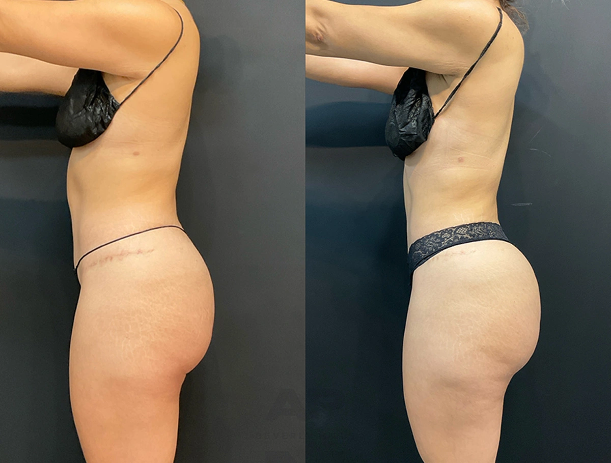 Real Patient Results by Dr. Marshall or Andrew P. Marshall Plastic Surgery serving Beverly Hills & Los Angeles, CA