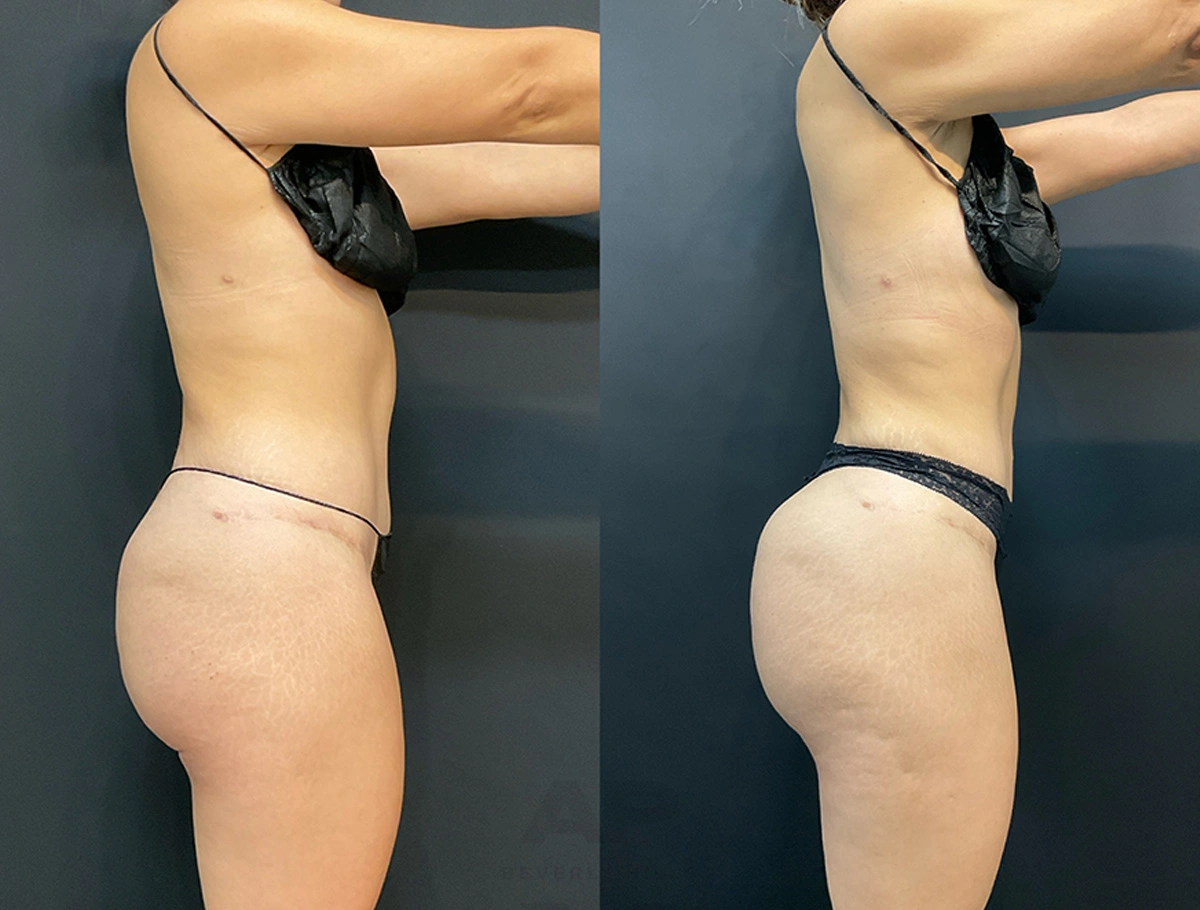 Real Patient Results by Dr. Marshall or Andrew P. Marshall Plastic Surgery serving Beverly Hills & Los Angeles, CA