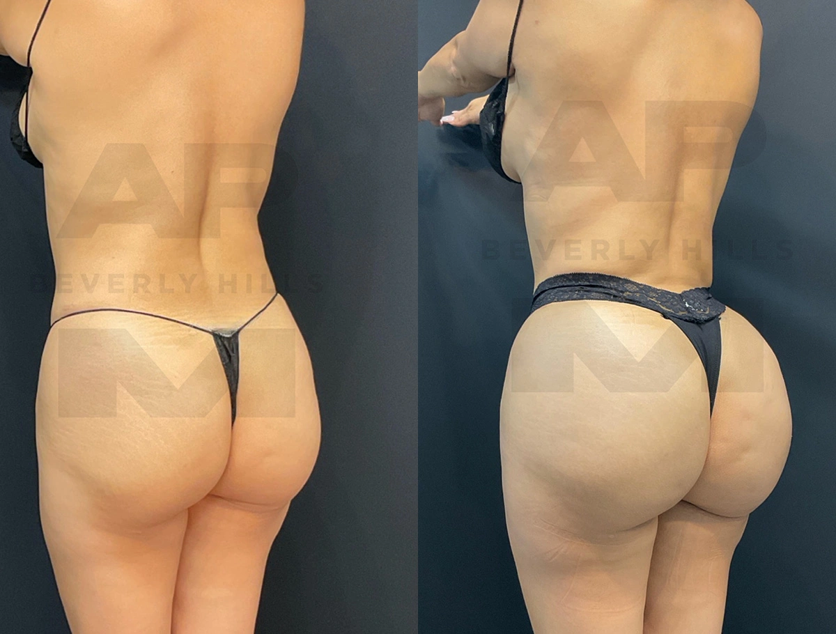 Real Patient Results by Dr. Marshall or Andrew P. Marshall Plastic Surgery serving Beverly Hills & Los Angeles, CA