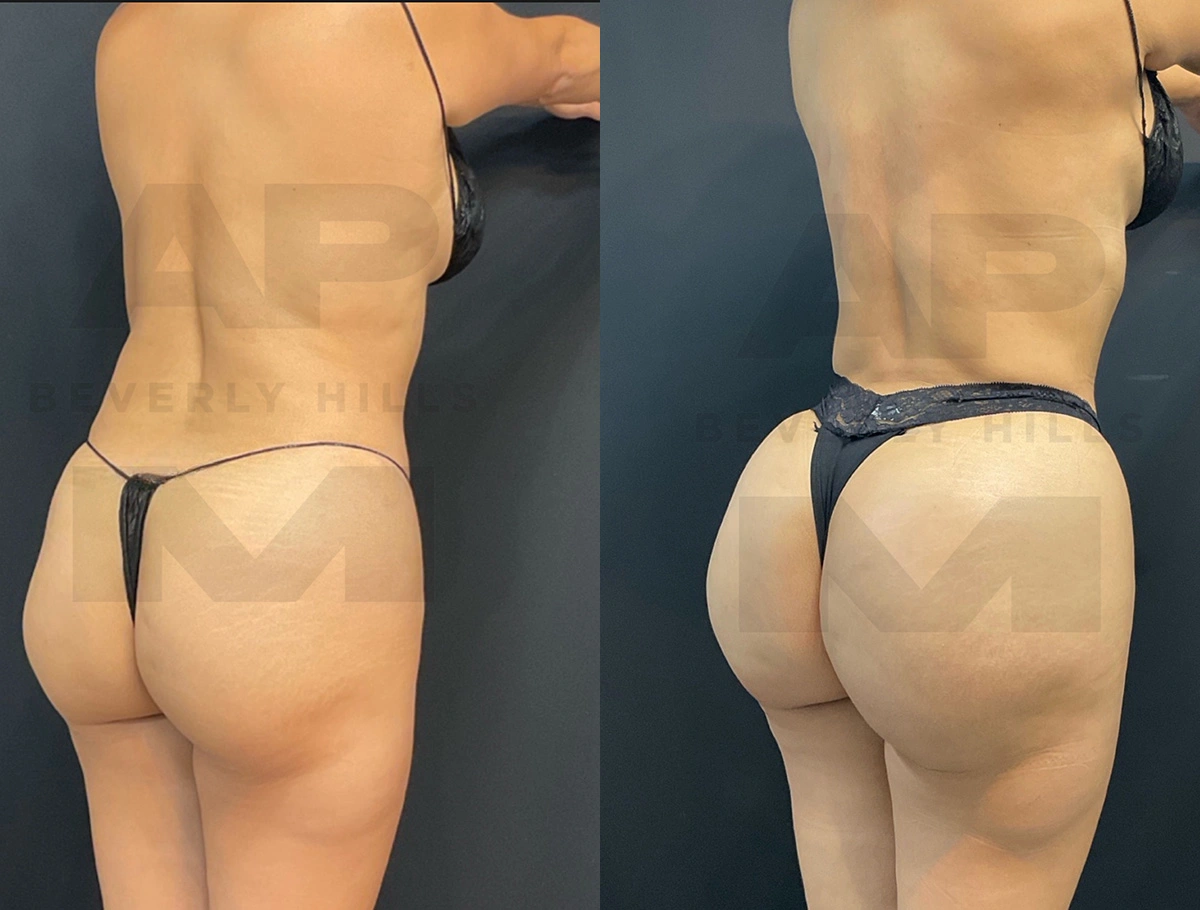 Real Patient Results by Dr. Marshall or Andrew P. Marshall Plastic Surgery serving Beverly Hills & Los Angeles, CA