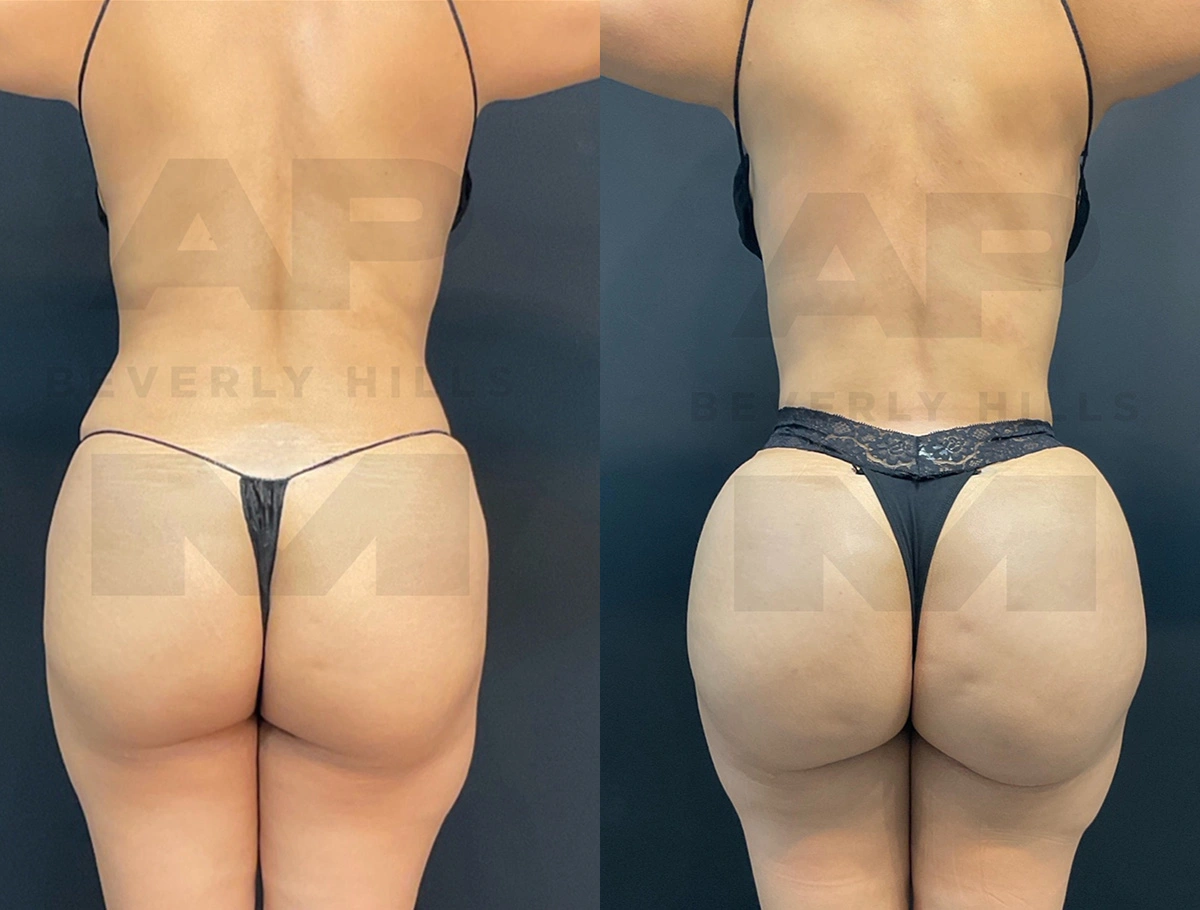 Real Patient Results by Dr. Marshall or Andrew P. Marshall Plastic Surgery serving Beverly Hills & Los Angeles, CA