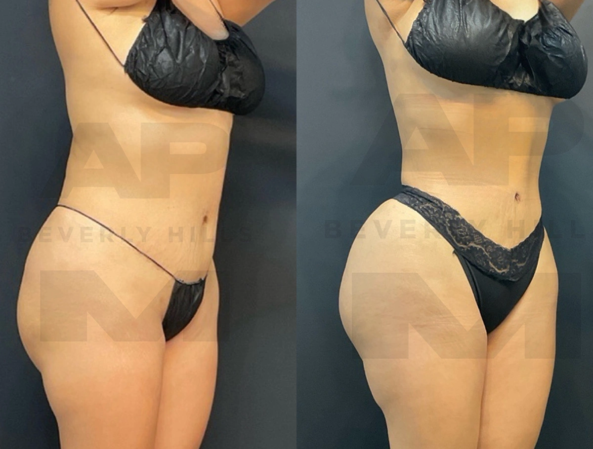 Real Patient Results by Dr. Marshall or Andrew P. Marshall Plastic Surgery serving Beverly Hills & Los Angeles, CA