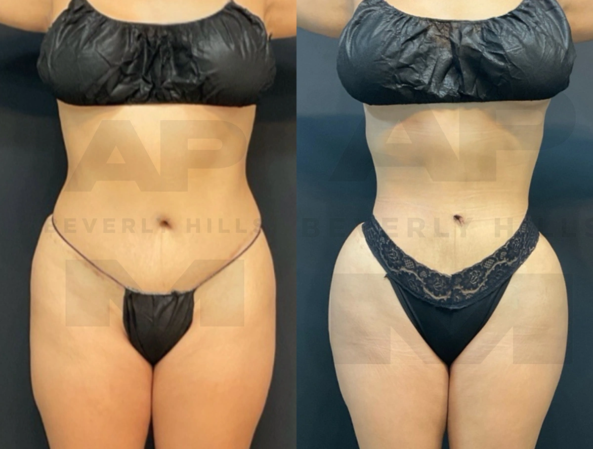 Real Patient Results by Dr. Marshall or Andrew P. Marshall Plastic Surgery serving Beverly Hills & Los Angeles, CA
