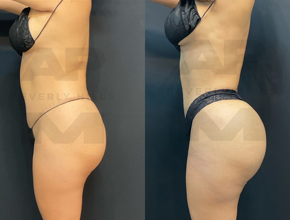 Real Patient Results by Dr. Marshall or Andrew P. Marshall Plastic Surgery serving Beverly Hills & Los Angeles, CA