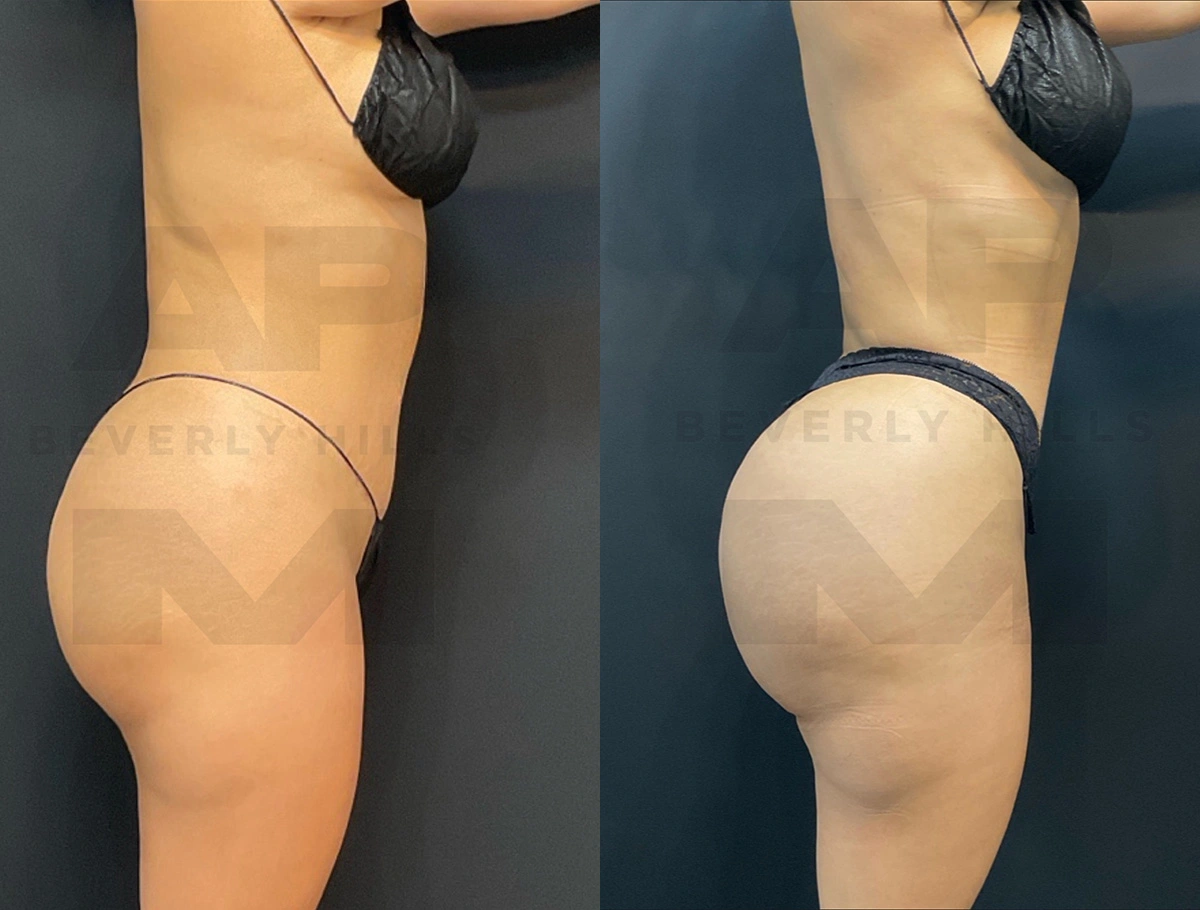 Real Patient Results by Dr. Marshall or Andrew P. Marshall Plastic Surgery serving Beverly Hills & Los Angeles, CA