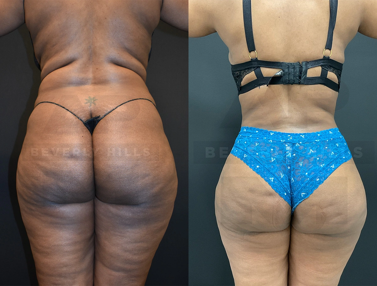 Real Patient Results by Dr. Marshall or Andrew P. Marshall Plastic Surgery serving Beverly Hills & Los Angeles, CA