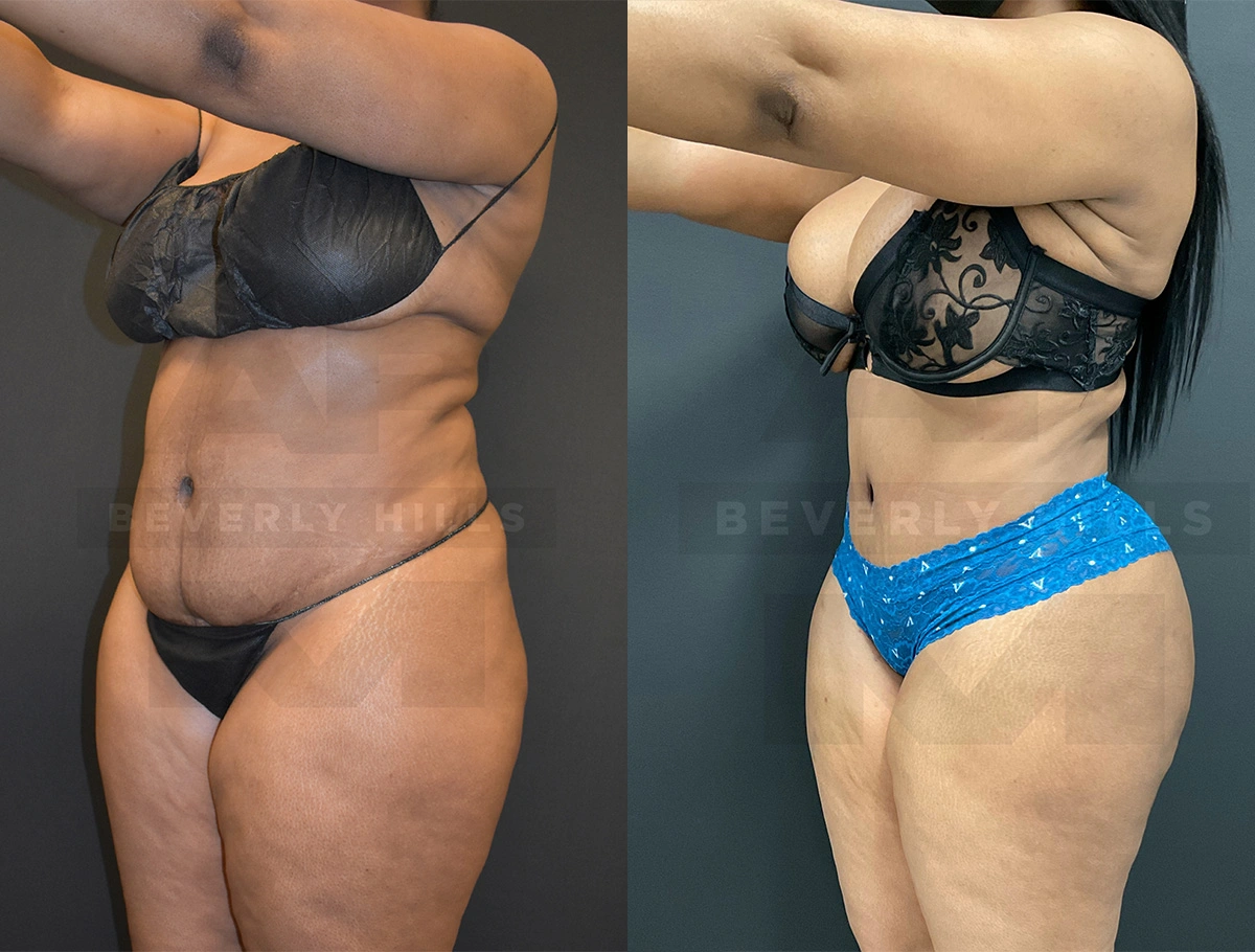 Real Patient Results by Dr. Marshall or Andrew P. Marshall Plastic Surgery serving Beverly Hills & Los Angeles, CA