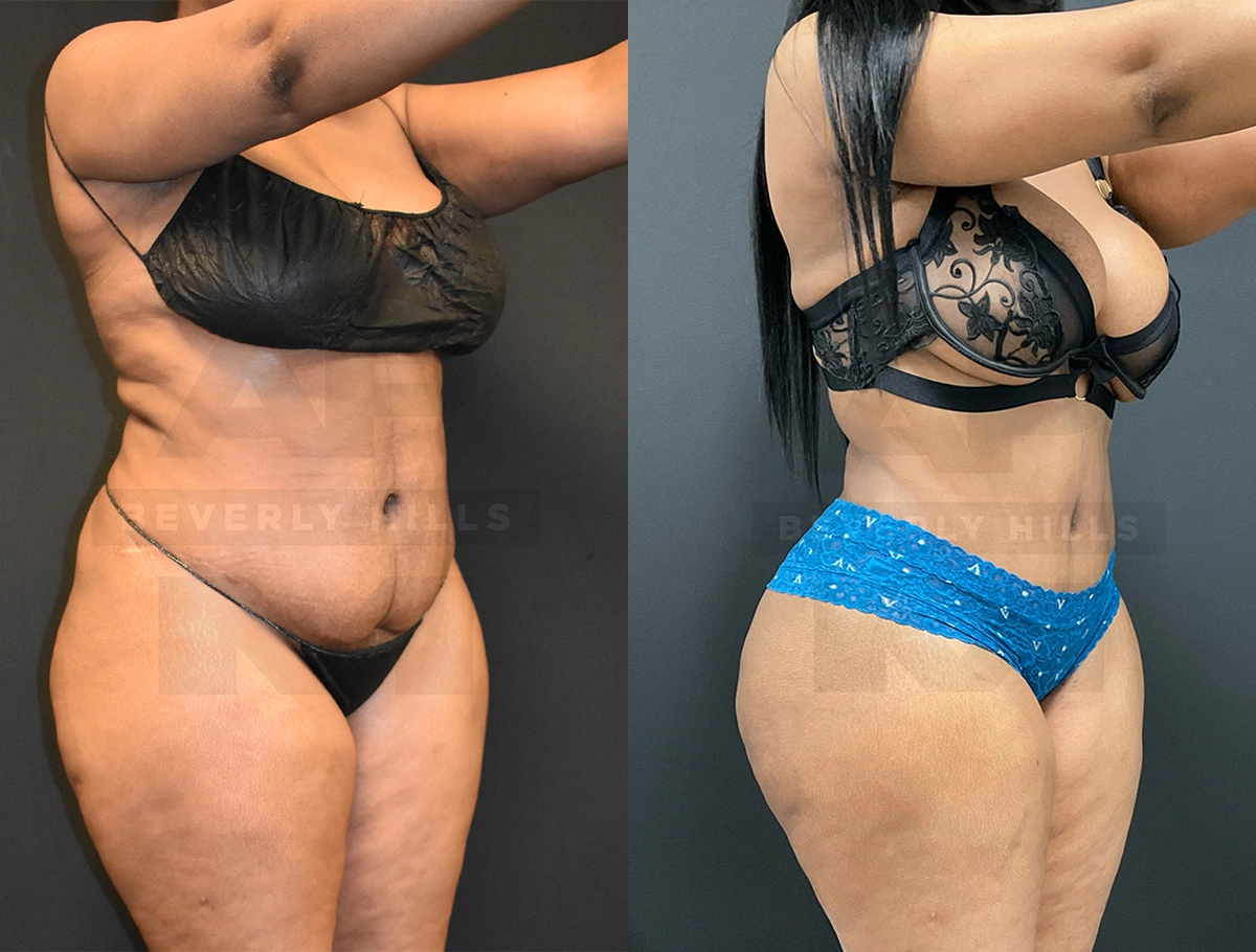 Real Patient Results by Dr. Marshall or Andrew P. Marshall Plastic Surgery serving Beverly Hills & Los Angeles, CA