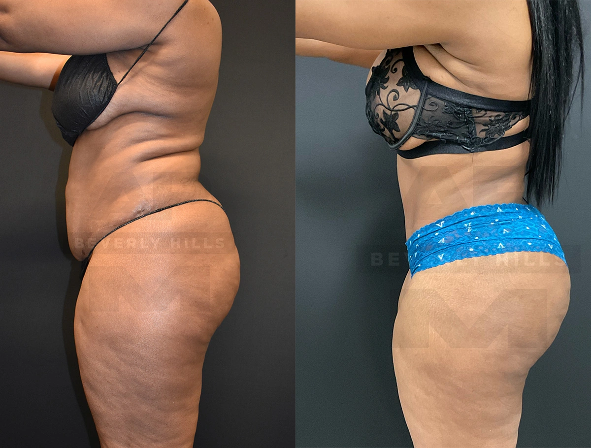 Real Patient Results by Dr. Marshall or Andrew P. Marshall Plastic Surgery serving Beverly Hills & Los Angeles, CA