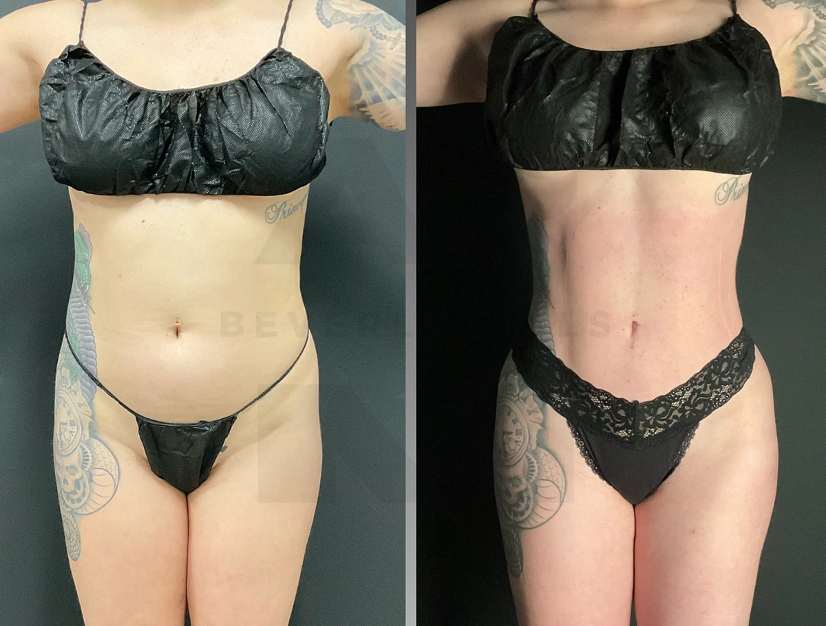 Real Patient Results by Dr. Marshall or Andrew P. Marshall Plastic Surgery serving Beverly Hills & Los Angeles, CA