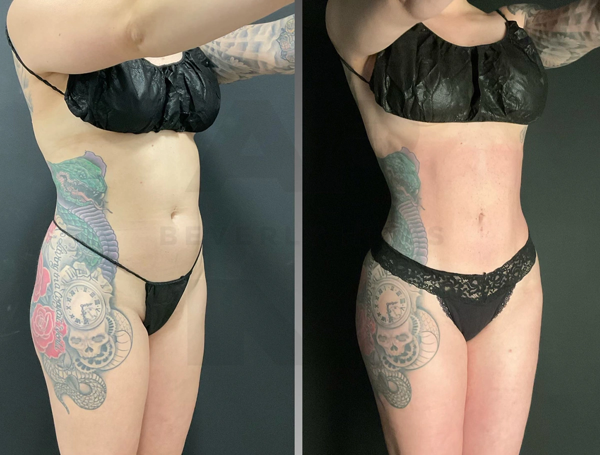 Real Patient Results by Dr. Marshall or Andrew P. Marshall Plastic Surgery serving Beverly Hills & Los Angeles, CA