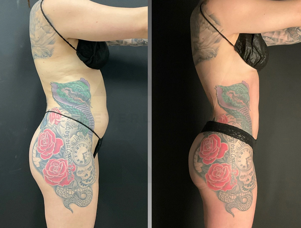 Real Patient Results by Dr. Marshall or Andrew P. Marshall Plastic Surgery serving Beverly Hills & Los Angeles, CA