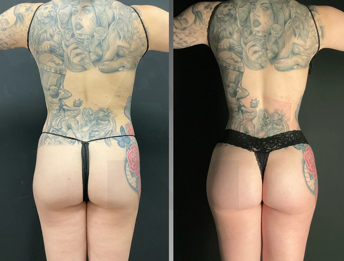 Real Patient Results by Dr. Marshall or Andrew P. Marshall Plastic Surgery serving Beverly Hills & Los Angeles, CA