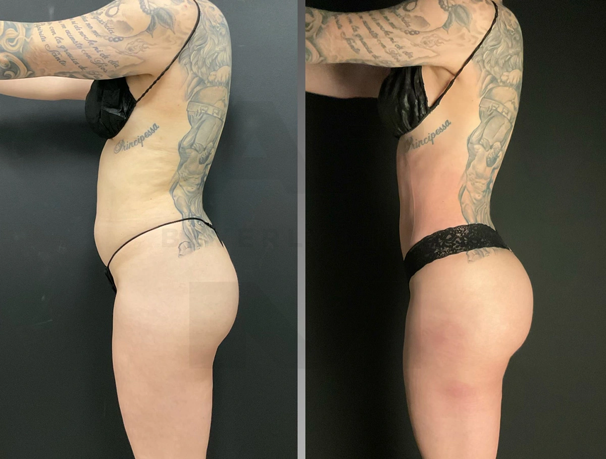 Real Patient Results by Dr. Marshall or Andrew P. Marshall Plastic Surgery serving Beverly Hills & Los Angeles, CA