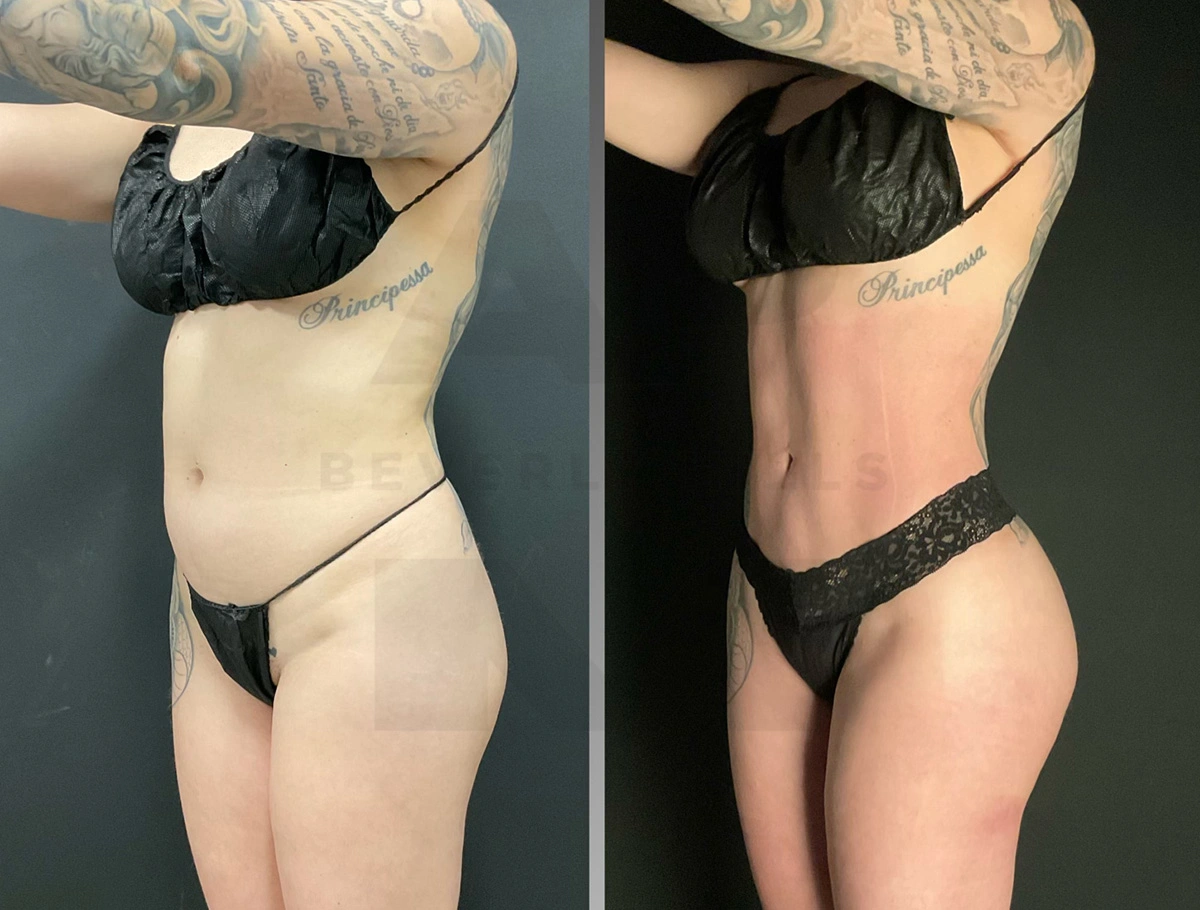 Real Patient Results by Dr. Marshall or Andrew P. Marshall Plastic Surgery serving Beverly Hills & Los Angeles, CA