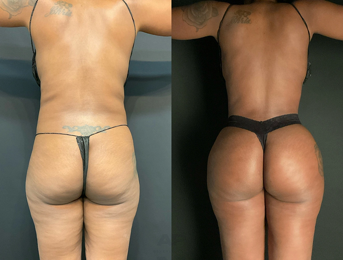 Real Patient Results by Dr. Marshall or Andrew P. Marshall Plastic Surgery serving Beverly Hills & Los Angeles, CA