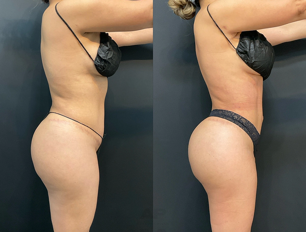 Real Patient Results by Dr. Marshall or Andrew P. Marshall Plastic Surgery serving Beverly Hills & Los Angeles, CA