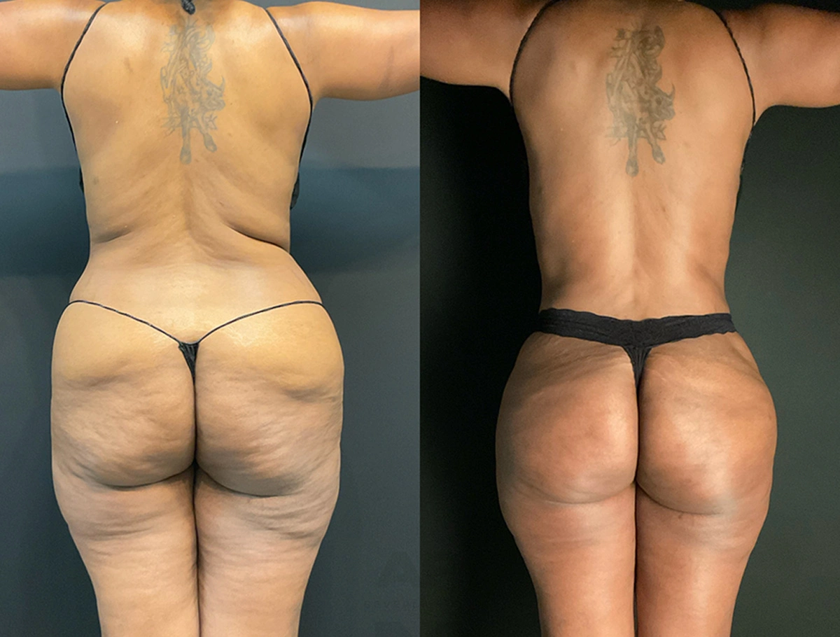 Real Patient Results by Dr. Marshall or Andrew P. Marshall Plastic Surgery serving Beverly Hills & Los Angeles, CA