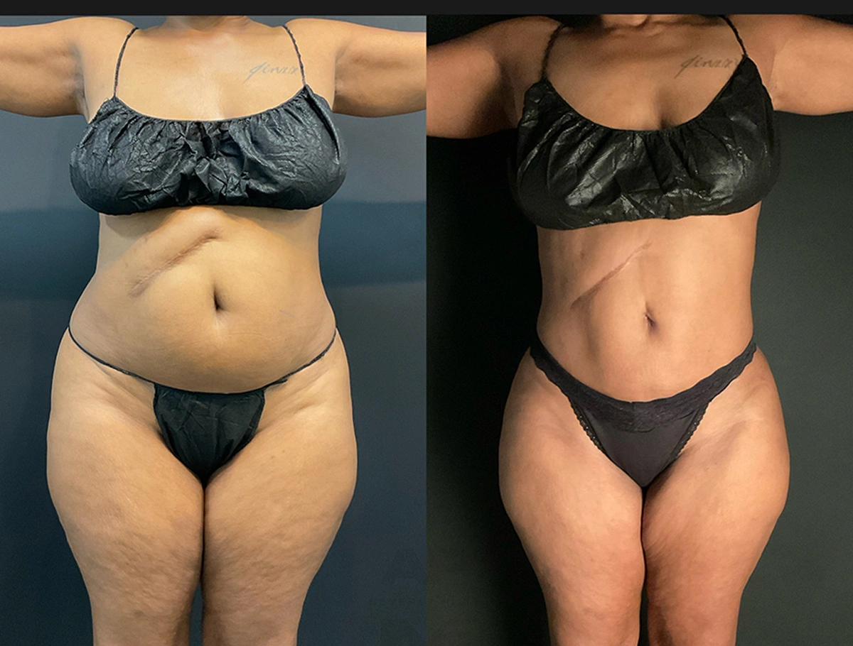 Real Patient Results by Dr. Marshall or Andrew P. Marshall Plastic Surgery serving Beverly Hills & Los Angeles, CA