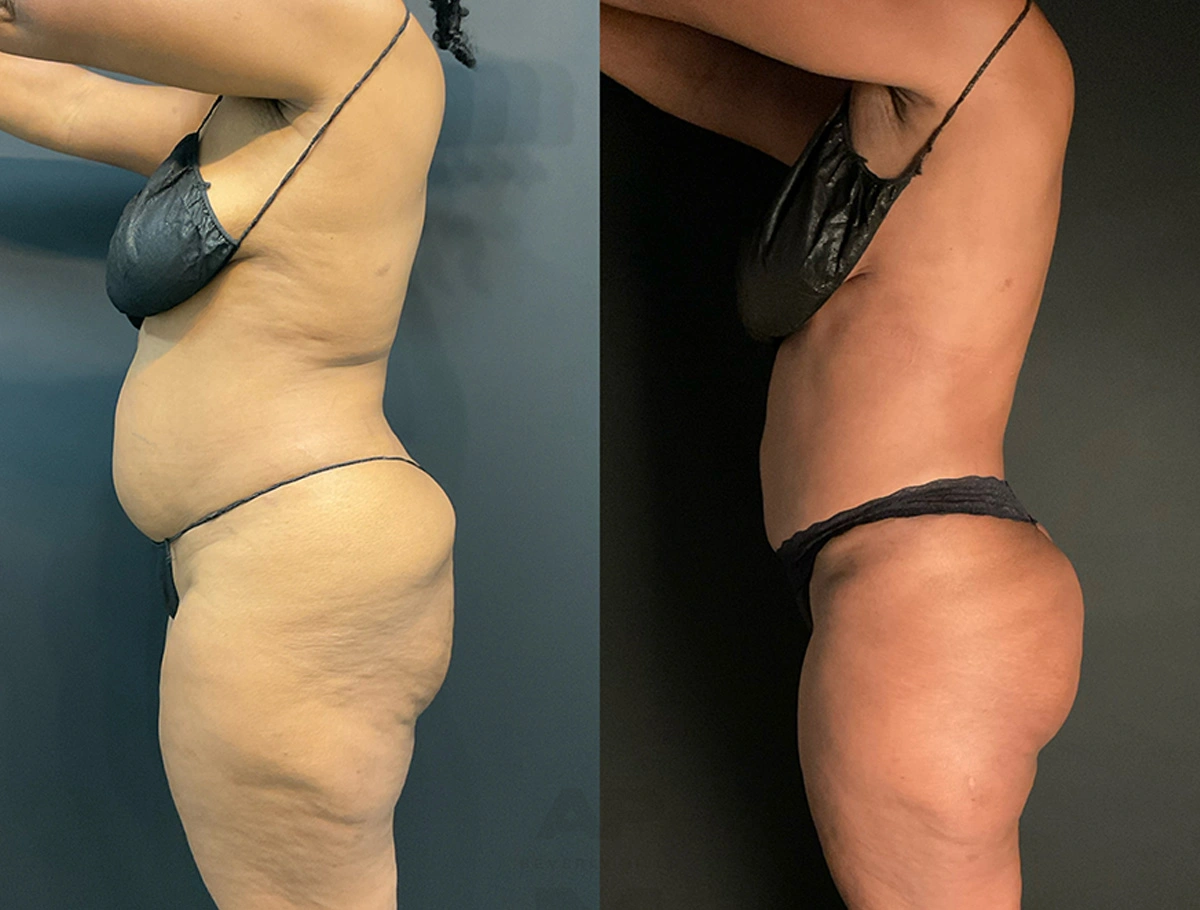 Real Patient Results by Dr. Marshall or Andrew P. Marshall Plastic Surgery serving Beverly Hills & Los Angeles, CA