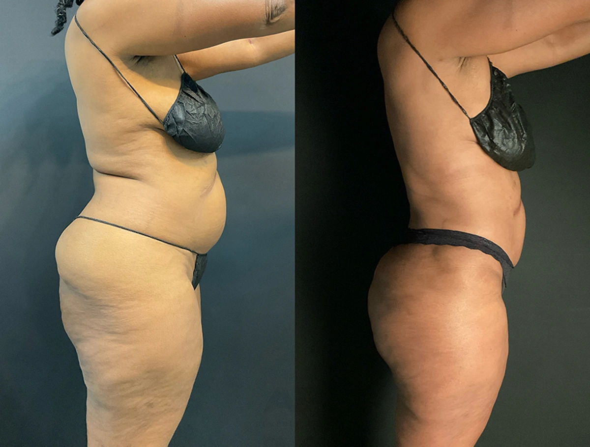 Real Patient Results by Dr. Marshall or Andrew P. Marshall Plastic Surgery serving Beverly Hills & Los Angeles, CA