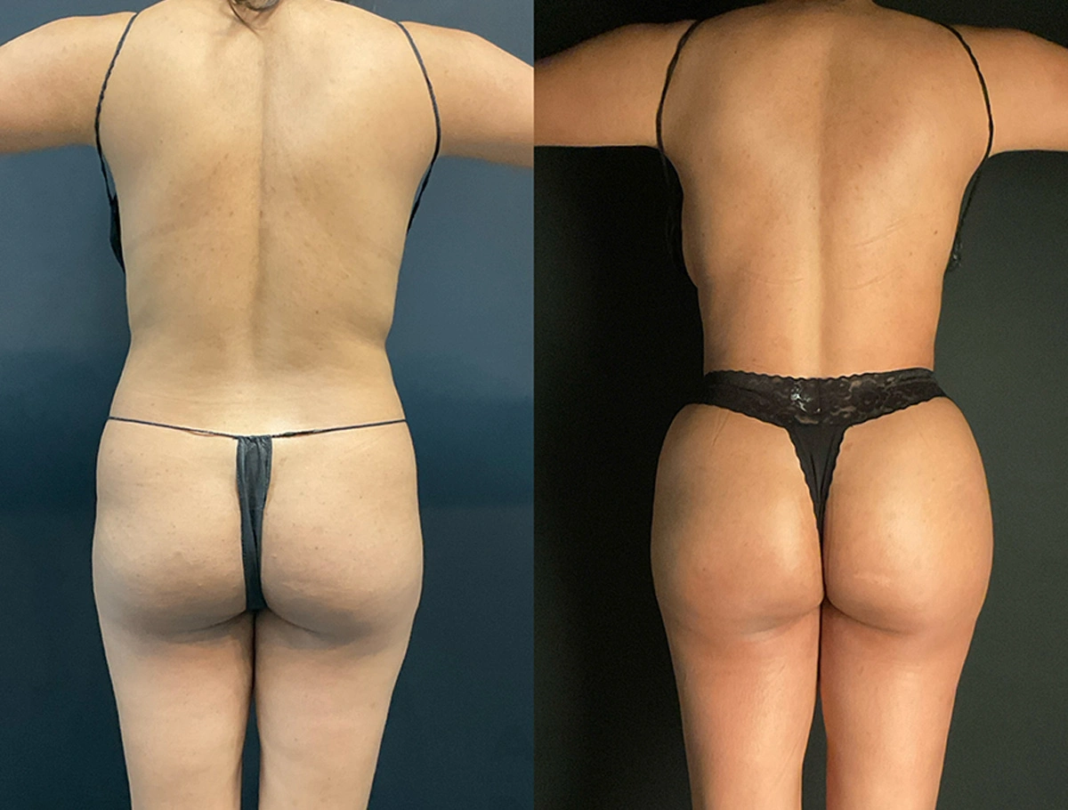 Real Patient Results by Dr. Marshall or Andrew P. Marshall Plastic Surgery serving Beverly Hills & Los Angeles, CA