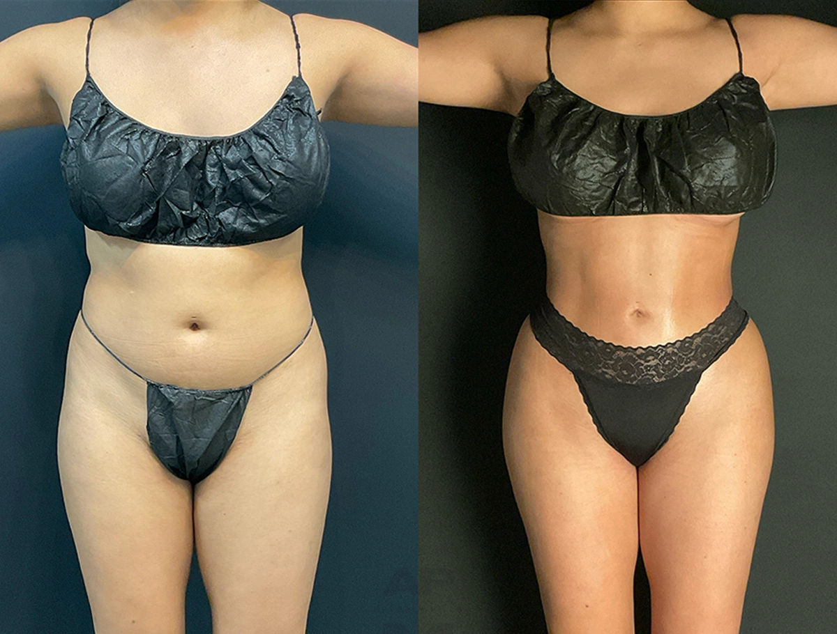 Real Patient Results by Dr. Marshall or Andrew P. Marshall Plastic Surgery serving Beverly Hills & Los Angeles, CA