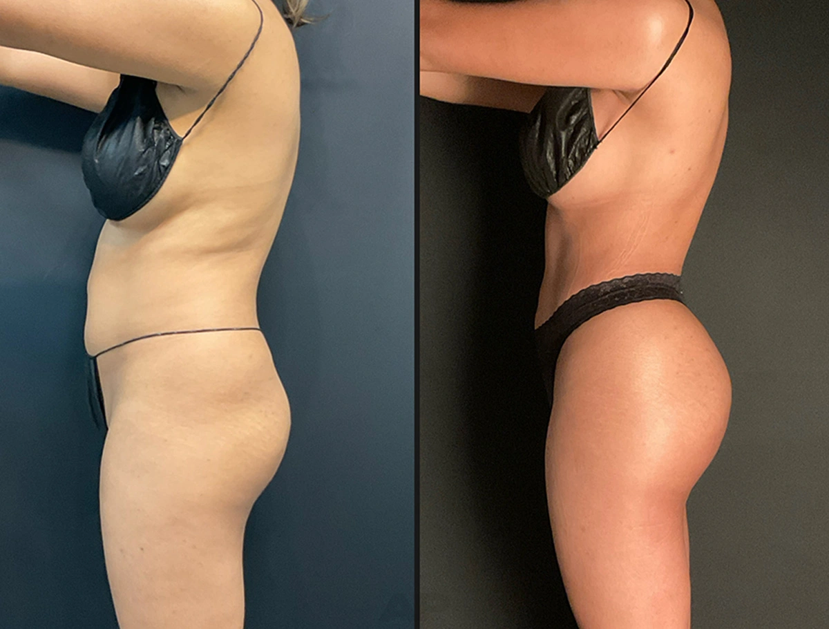 Real Patient Results by Dr. Marshall or Andrew P. Marshall Plastic Surgery serving Beverly Hills & Los Angeles, CA