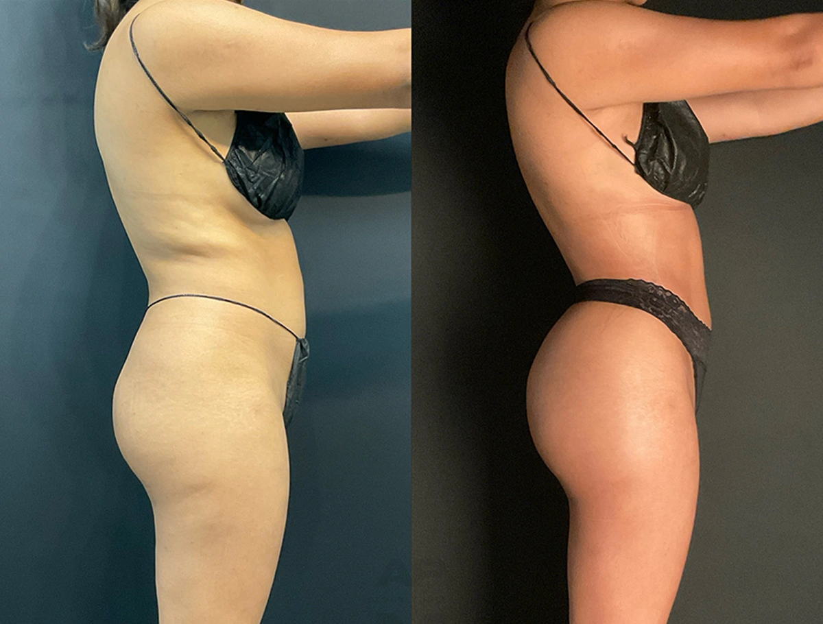 Real Patient Results by Dr. Marshall or Andrew P. Marshall Plastic Surgery serving Beverly Hills & Los Angeles, CA