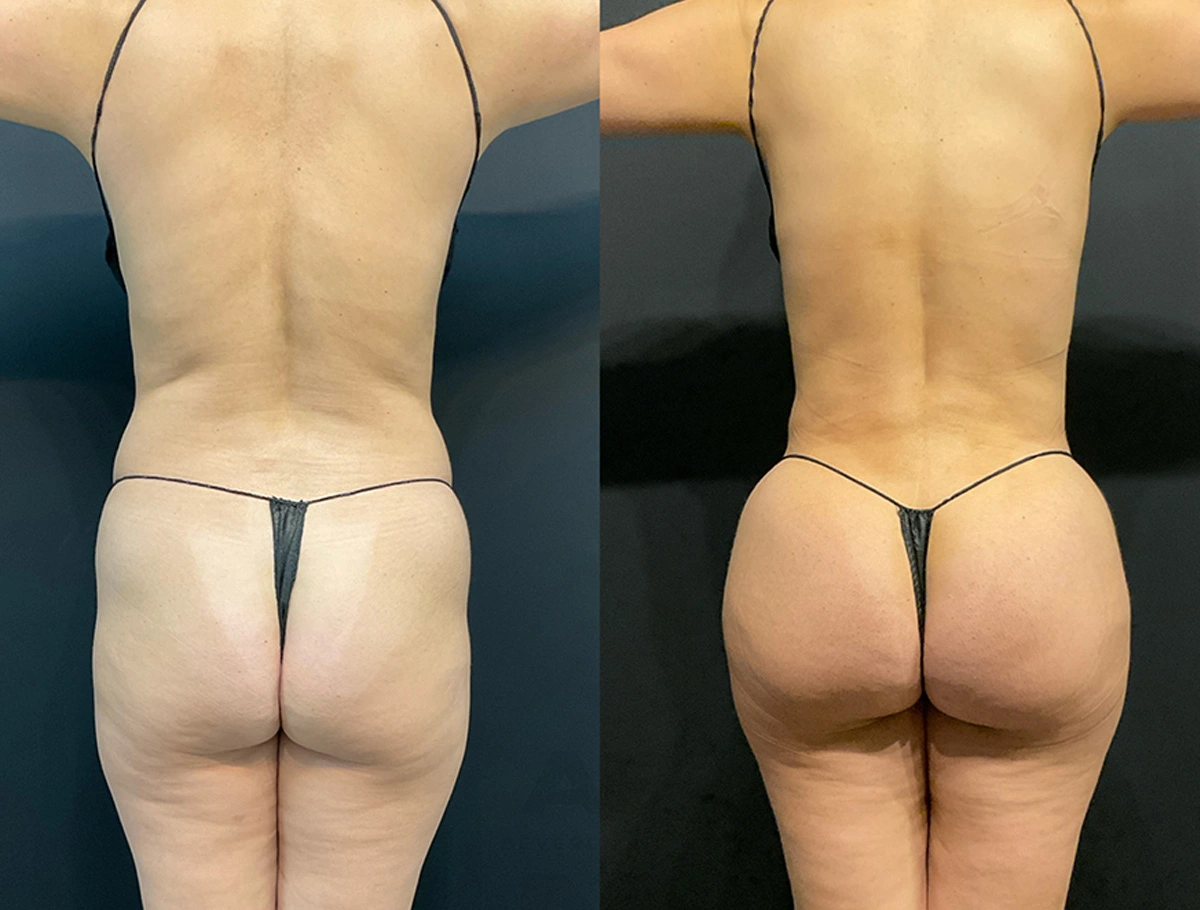 Real Patient Results by Dr. Marshall or Andrew P. Marshall Plastic Surgery serving Beverly Hills & Los Angeles, CA