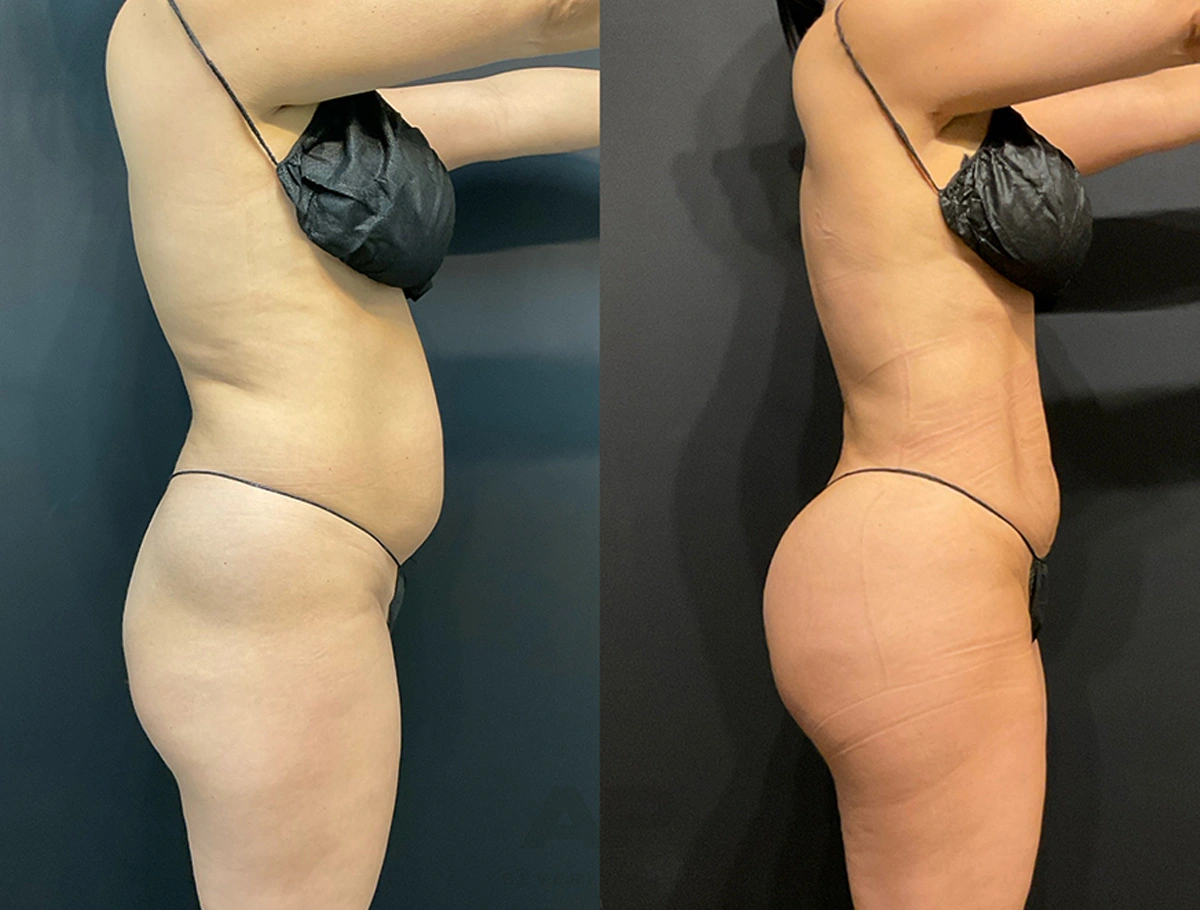 Real Patient Results by Dr. Marshall or Andrew P. Marshall Plastic Surgery serving Beverly Hills & Los Angeles, CA