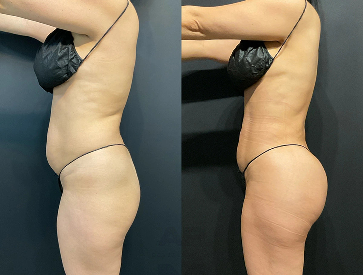 Real Patient Results by Dr. Marshall or Andrew P. Marshall Plastic Surgery serving Beverly Hills & Los Angeles, CA