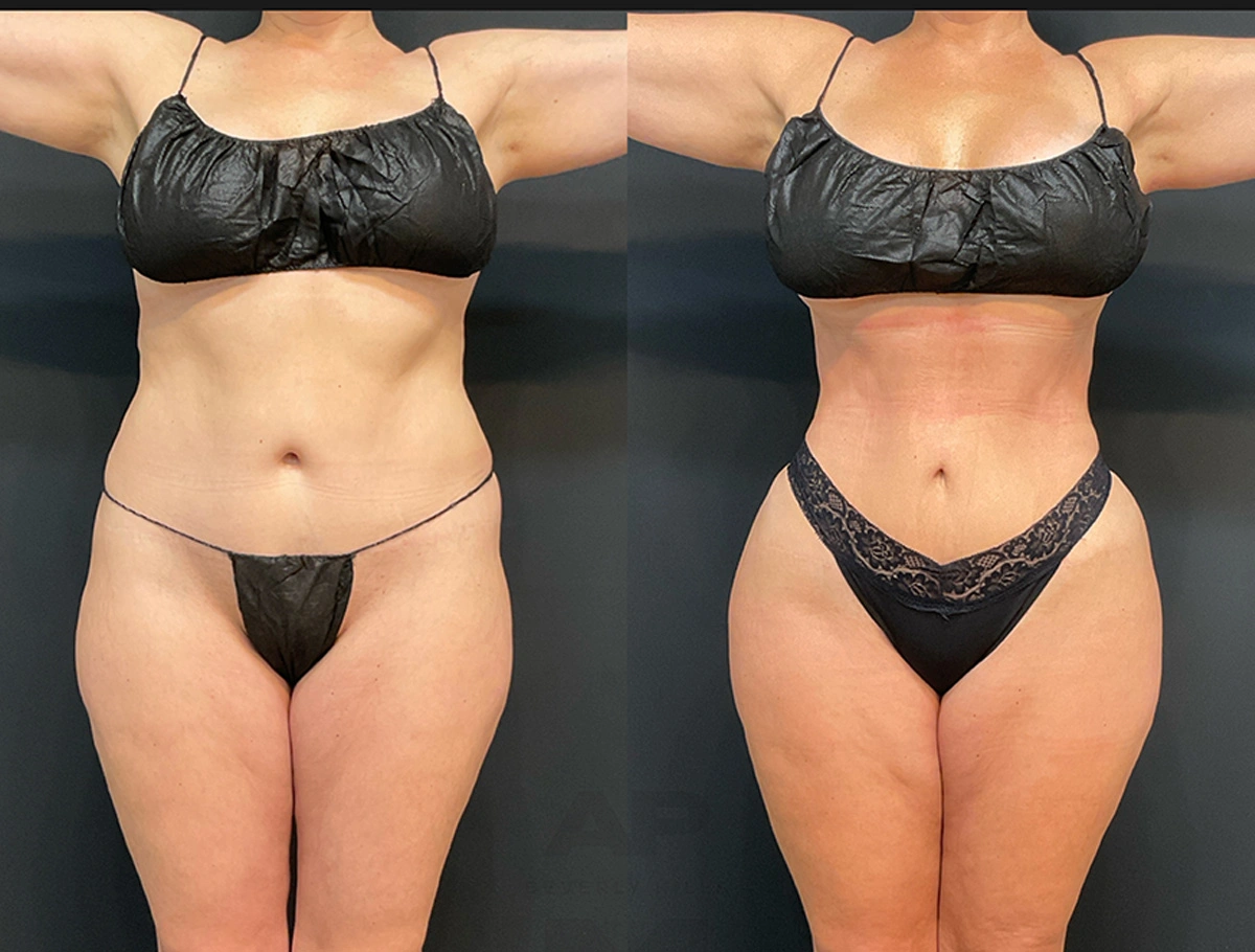 Real Patient Results by Dr. Marshall or Andrew P. Marshall Plastic Surgery serving Beverly Hills & Los Angeles, CA