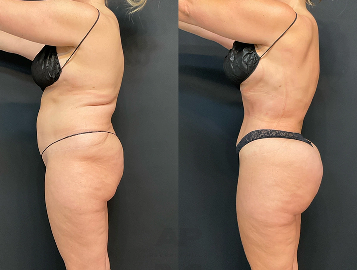 Real Patient Results by Dr. Marshall or Andrew P. Marshall Plastic Surgery serving Beverly Hills & Los Angeles, CA