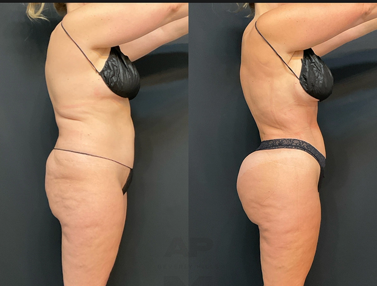 Real Patient Results by Dr. Marshall or Andrew P. Marshall Plastic Surgery serving Beverly Hills & Los Angeles, CA