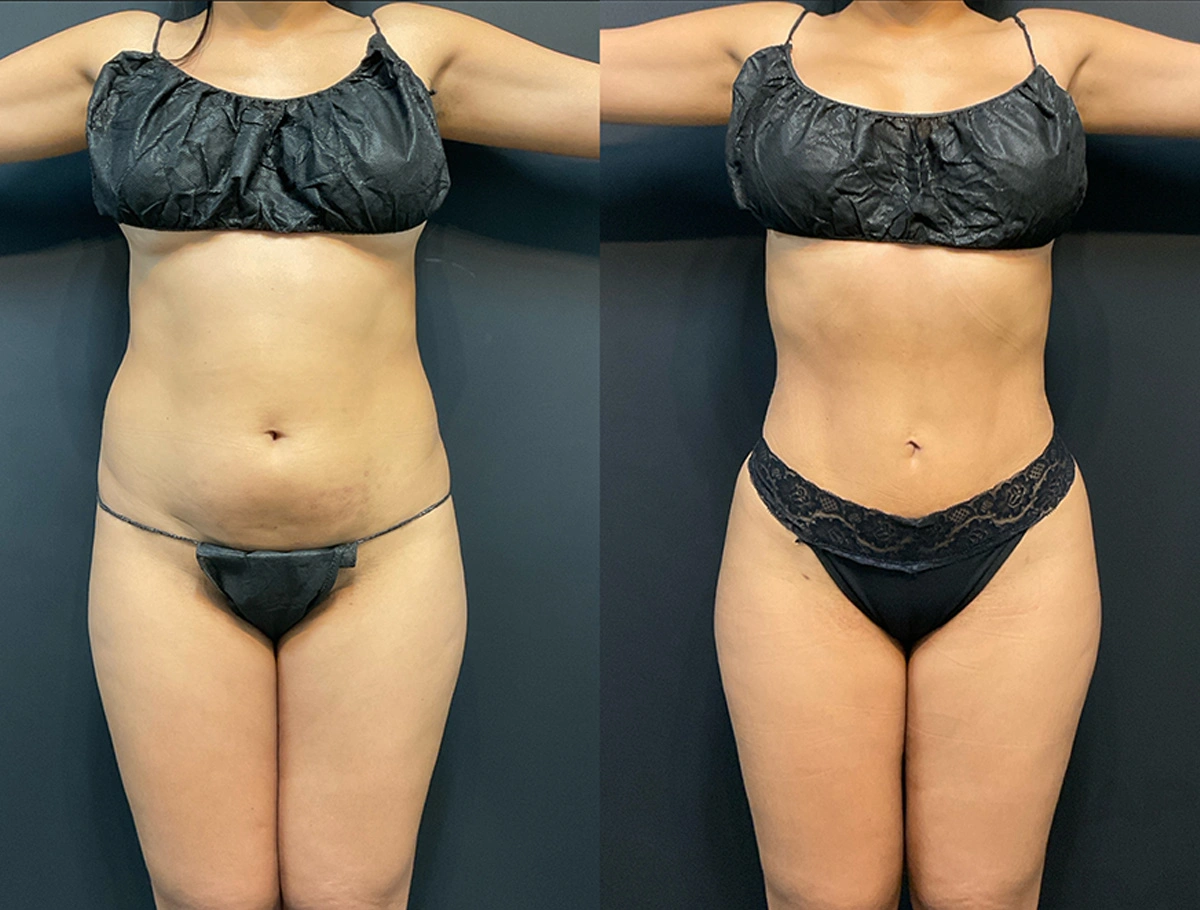 Real Patient Results by Dr. Marshall or Andrew P. Marshall Plastic Surgery serving Beverly Hills & Los Angeles, CA