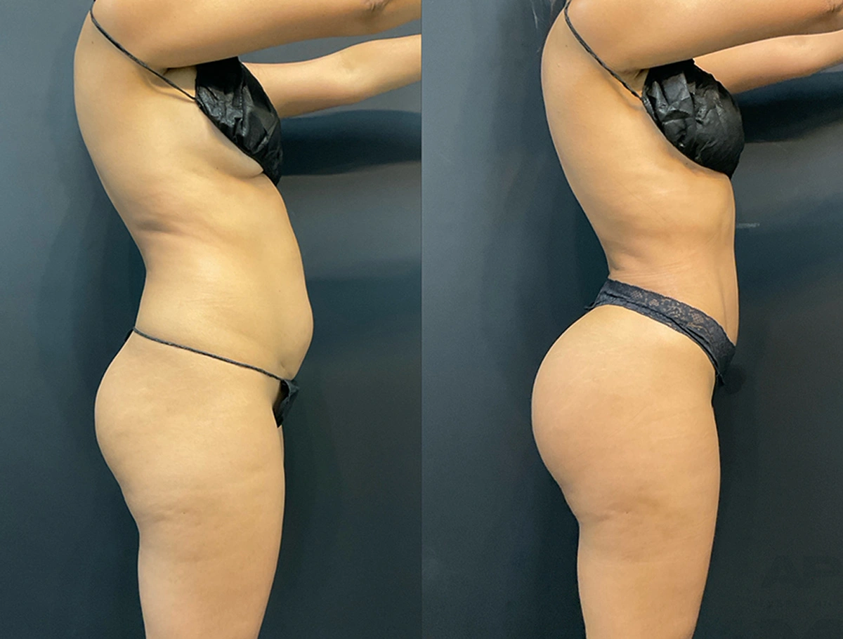 Real Patient Results by Dr. Marshall or Andrew P. Marshall Plastic Surgery serving Beverly Hills & Los Angeles, CA