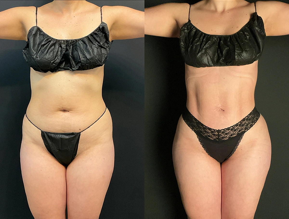 Real Patient Results by Dr. Marshall or Andrew P. Marshall Plastic Surgery serving Beverly Hills & Los Angeles, CA