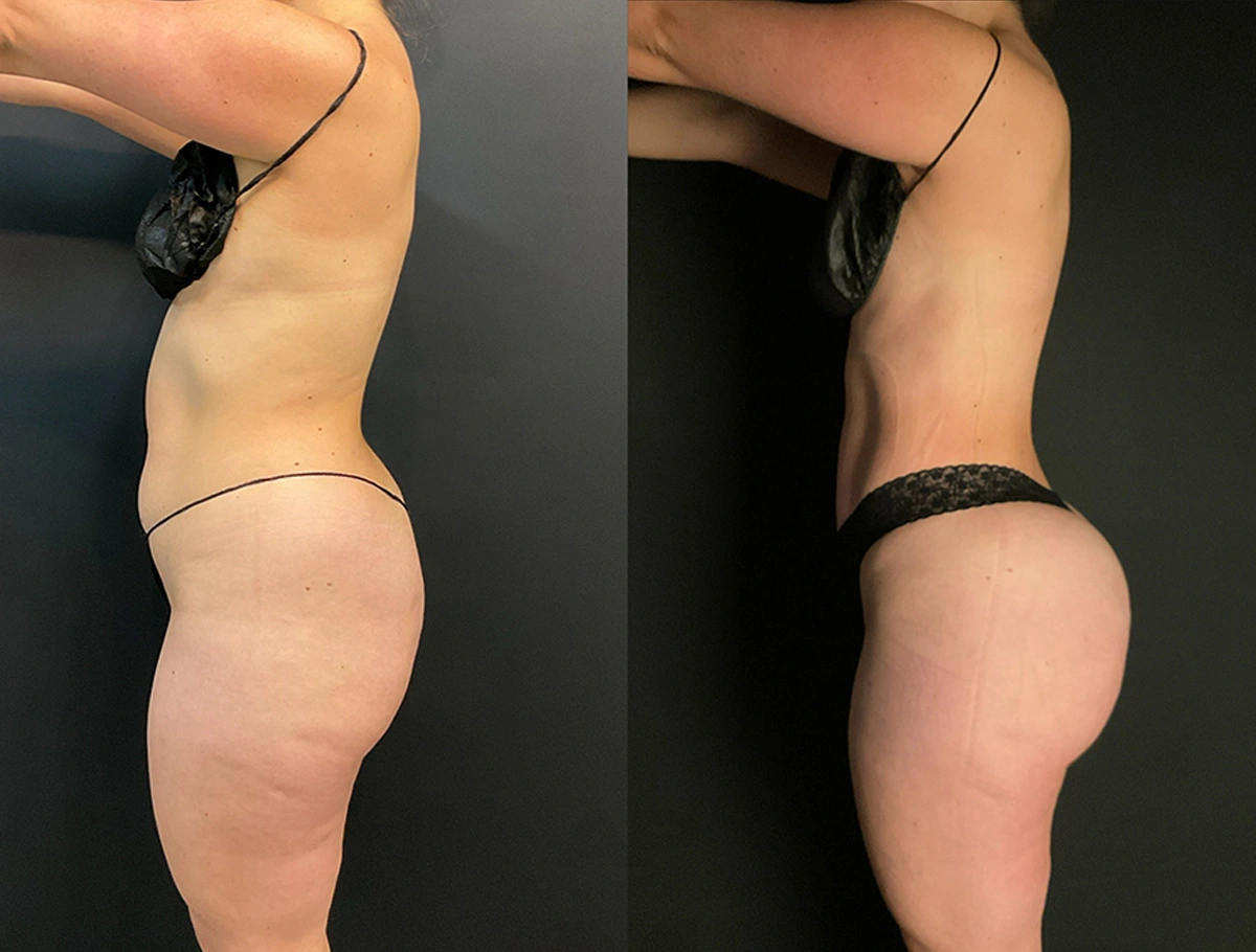 Real Patient Results by Dr. Marshall or Andrew P. Marshall Plastic Surgery serving Beverly Hills & Los Angeles, CA